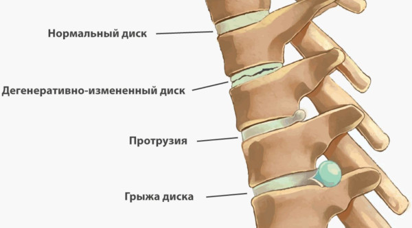 Межпозвоночные диски. Строение, анатомия, функции