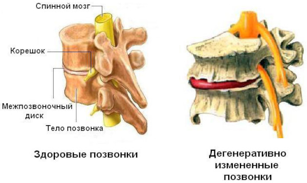 Межпозвоночные диски. Строение, анатомия, функции