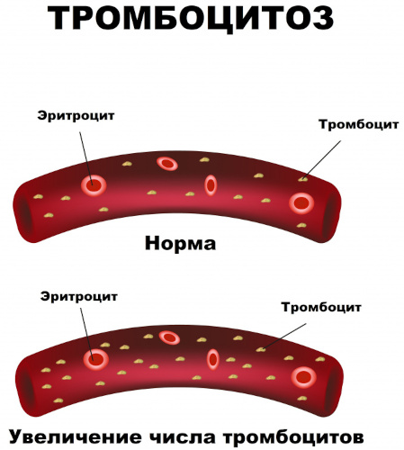 MPV (средний объем тромбоцитов) в анализе крови. Что это такое, норма