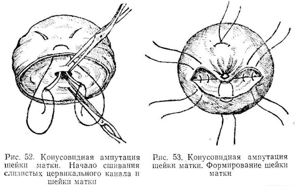 Пластика шейки матки. Как проходит операция по Эммету, Штурмдорфу