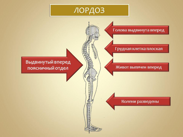 Поясничный лордоз сглажен (выпрямлен). Что это значит у взрослого, прогноз