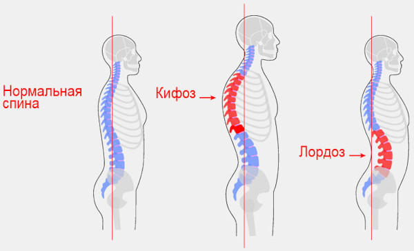 Поясничный лордоз сглажен (выпрямлен). Что это значит у взрослого, прогноз