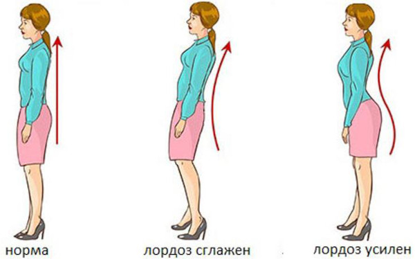 Поясничный лордоз сглажен (выпрямлен). Что это значит у взрослого, прогноз