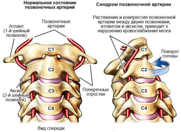 Синдром позвоночной артерии при шейном остеохондрозе Барре-Льеу, шейная мигрень