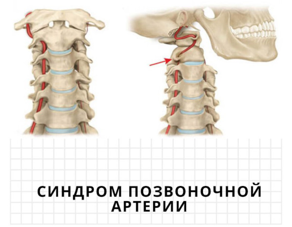 Синдром позвоночной артерии при шейном остеохондрозе Барре-Льеу, шейная мигрень