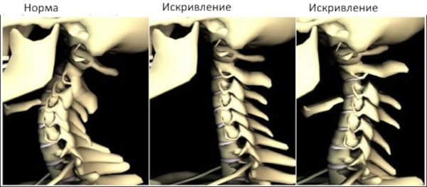 Сколиоз шейного отдела позвоночника 1 степени у взрослых. Симптомы