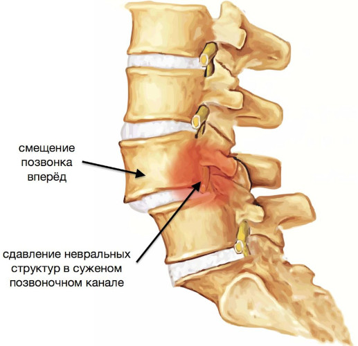 Смещение позвонков поясничного отдела. Лечение, симптомы, упражнения