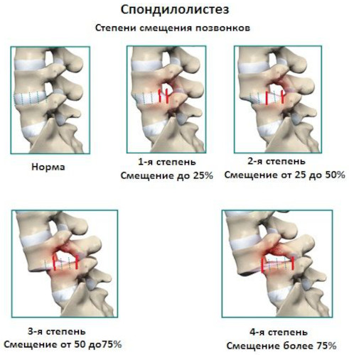 Смещение позвонков поясничного отдела. Лечение, симптомы, упражнения