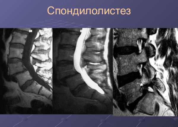 Смещение позвонков поясничного отдела. Лечение, симптомы, упражнения