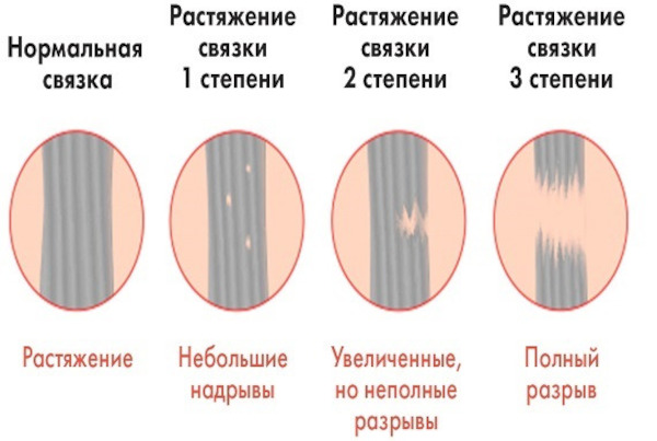 Сорвал спину. Что делать при растяжении мышц спины. Лечение, мази, уколы