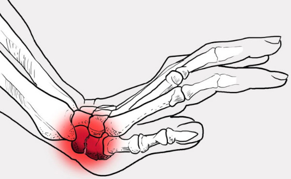 Вывих кисти руки. Лечение, что делать, симптомы, рентген