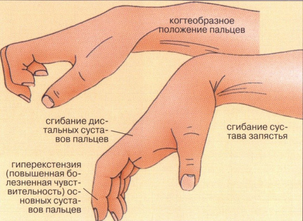 Вывих кисти руки. Лечение, что делать, симптомы, рентген