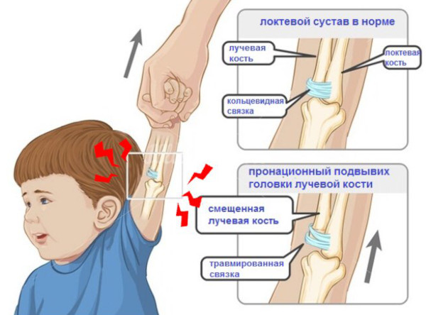 Вывих локтевого сустава у детей. Симптомы, восстановление, лечение