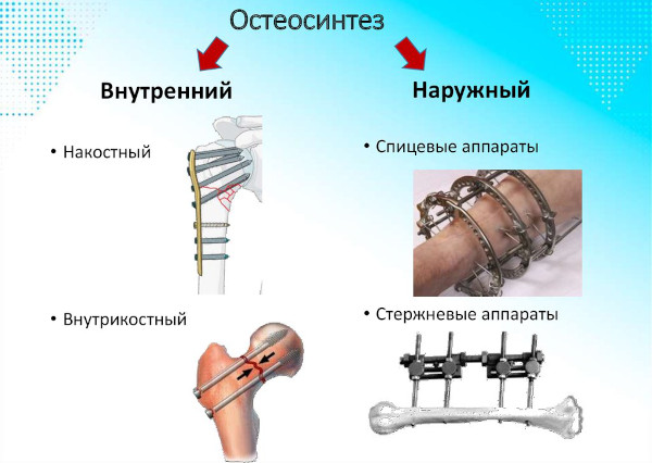 Вывих локтевого сустава у детей. Симптомы, восстановление, лечение