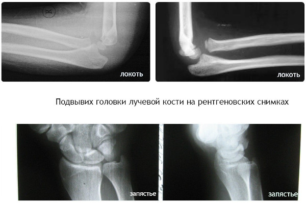 Вывих локтевого сустава у детей. Симптомы, восстановление, лечение