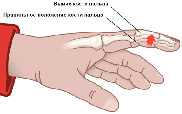 Вывих пальца кисти на руке у взрослых. Признаки, как вправить