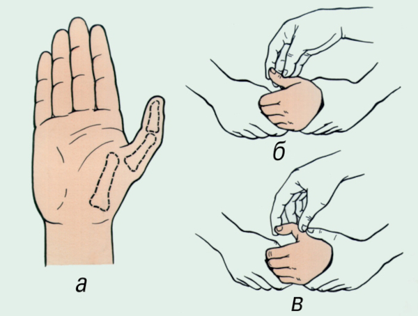 Вывих пальца кисти на руке у взрослых. Признаки, как вправить
