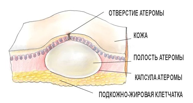 Атерома волосистой части головы (маленькая шишка). Лечение, удаление