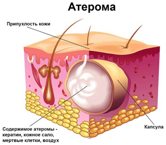 Атерома волосистой части головы (маленькая шишка). Лечение, удаление