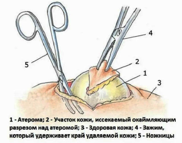 Атерома волосистой части головы (маленькая шишка). Лечение, удаление