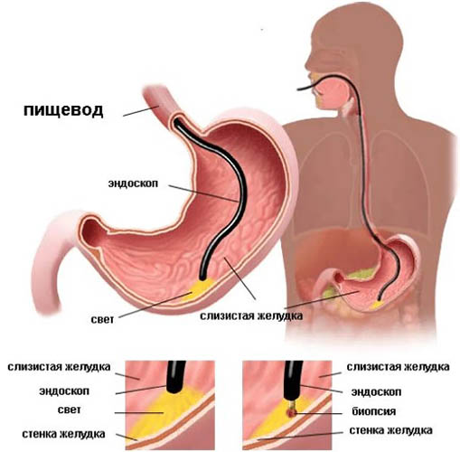 Эндоскопия желудка. Что это такое, исследование, подготовка