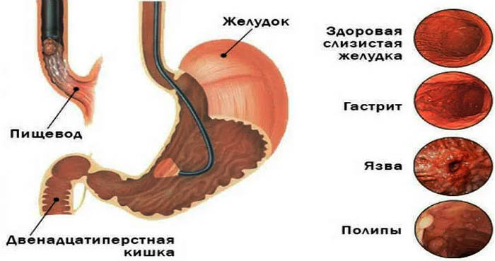 Эндоскопия желудка. Что это такое, исследование, подготовка