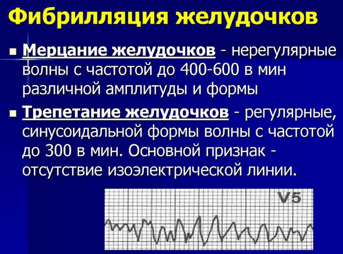 Фибрилляция желудочков. Это что такое