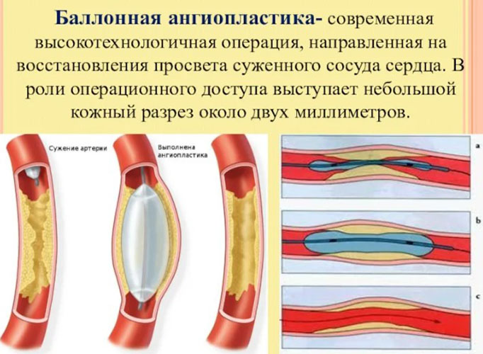 Фибрилляция желудочков. Это что такое