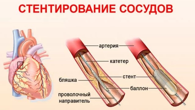 Фибрилляция желудочков. Это что такое