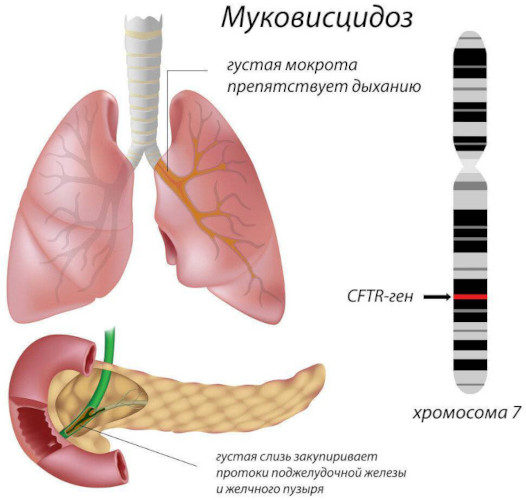 Хромосомные мутации (аберрации, перестройки). Что это такое, примеры