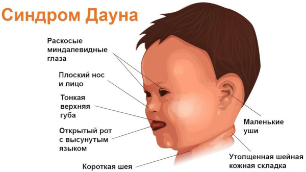 Хромосомные мутации (аберрации, перестройки). Что это такое, примеры