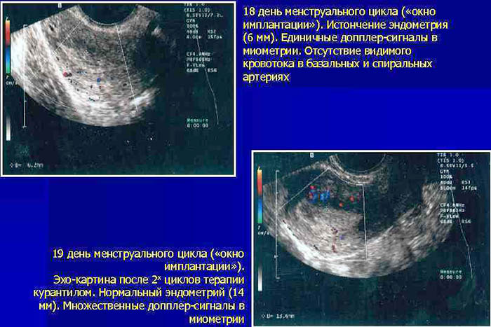 Имплантационное окно при ЭКО. Как определить в криопротоколе