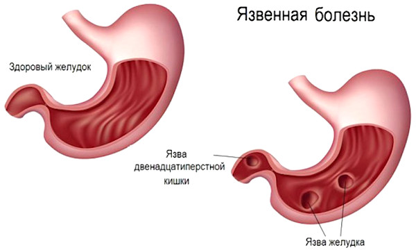 Катаральный (простой, банальный) гастрит. Что это такое, лечение