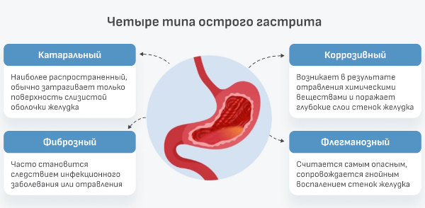 Катаральный (простой, банальный) гастрит. Что это такое, лечение