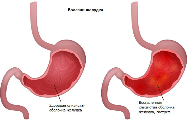 Катаральный (простой, банальный) гастрит. Что это такое, лечение
