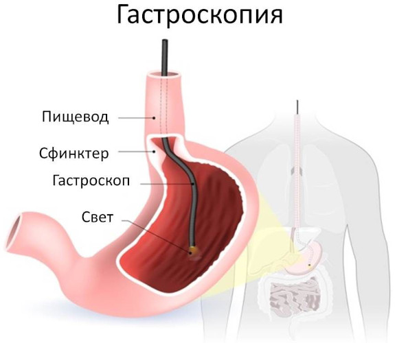 Кислая отрыжка. Причины у взрослого после еды, ночью