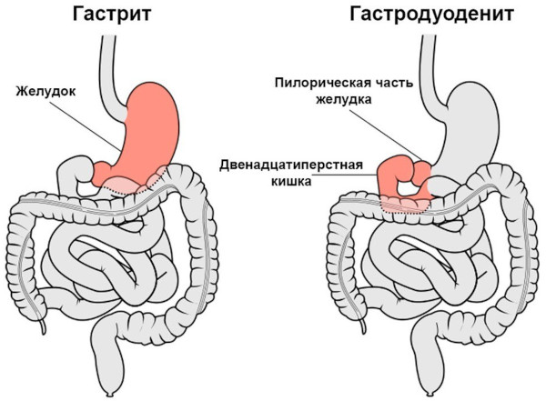 Кислая отрыжка. Причины у взрослого после еды, ночью