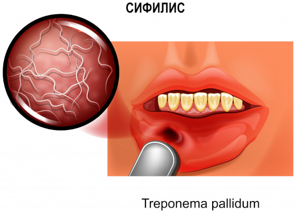Лечение сифилиса. Схема, препараты