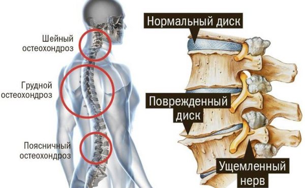 Можно ли вылечить остеохондроз полностью навсегда шейного, поясничного, грудного отдела