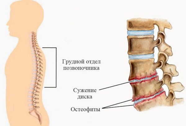 Можно ли вылечить остеохондроз полностью навсегда шейного, поясничного, грудного отдела