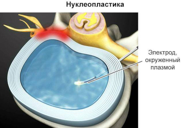 Невралгия (воспаление, неврит) затылочного нерва. Симптомы и лечение