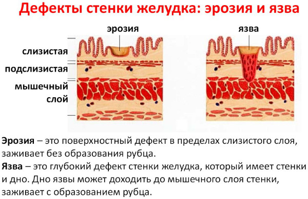 Опасность гастрита желудка у детей с повышенной кислотностью