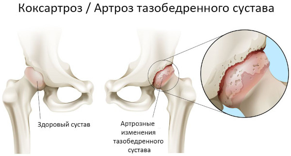 Остеоартроз тазобедренного сустава. Степени, лечение