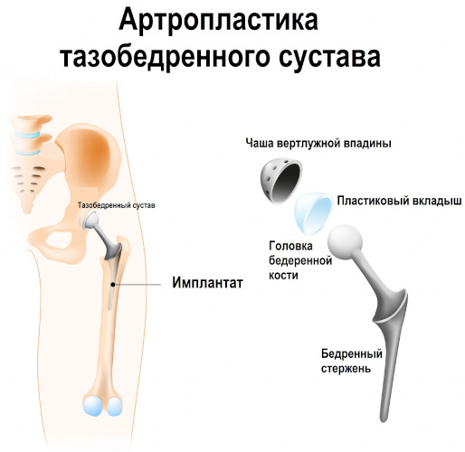 Остеоартроз тазобедренного сустава. Степени, лечение