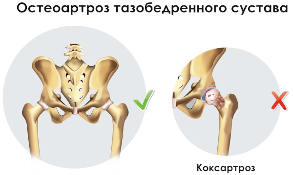 Остеоартроз тазобедренного сустава. Степени, лечение