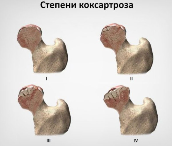 Остеоартроз тазобедренного сустава. Степени, лечение