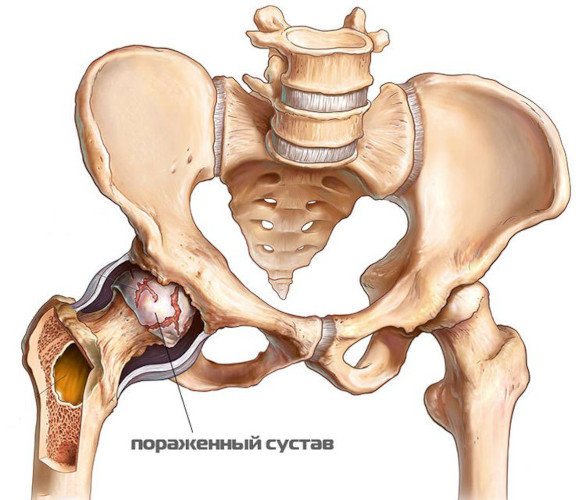 Остеоартроз тазобедренного сустава. Степени, лечение