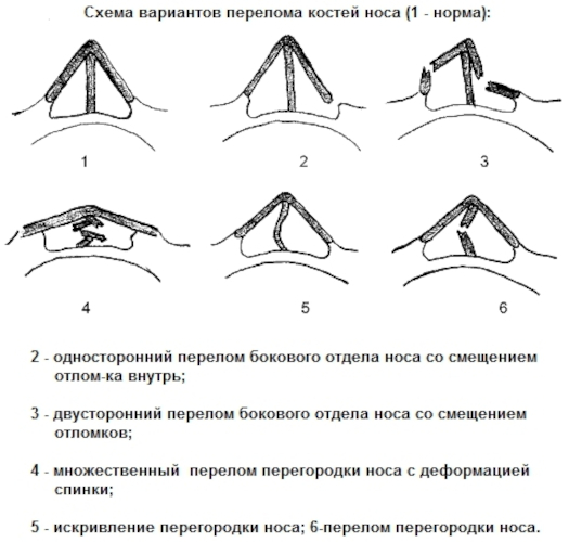 Перелом костей носа. Как определить степень тяжести