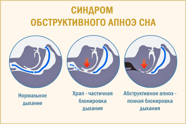 Перелом костей носа. Как определить степень тяжести