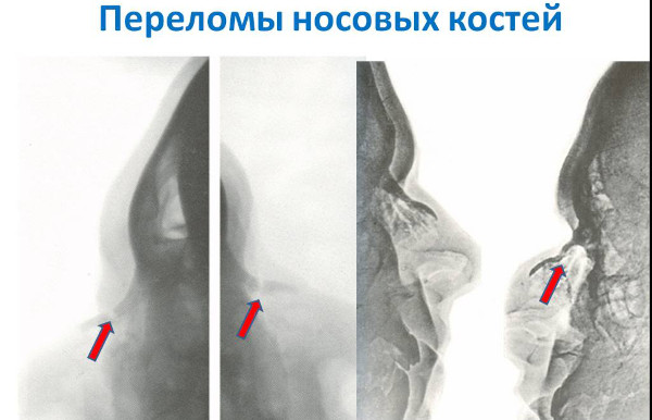 Перелом костей носа. Как определить степень тяжести